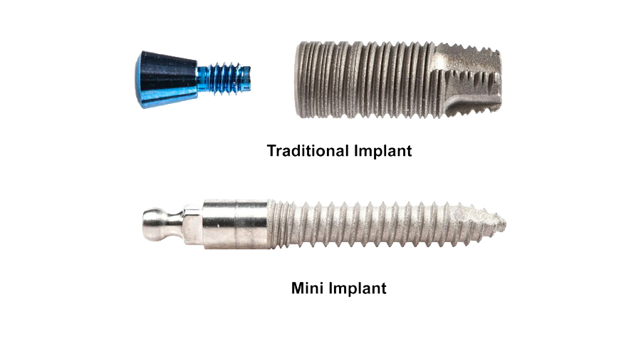 A traditional dental implant next to a mini dental implant